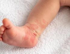 宝爸宝妈们，当心宝宝身上的“红胎记”